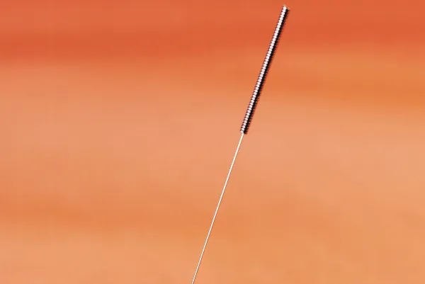 当院の花粉症を改善する施術 その1「鍼の施術」